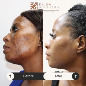 Before and After Pics